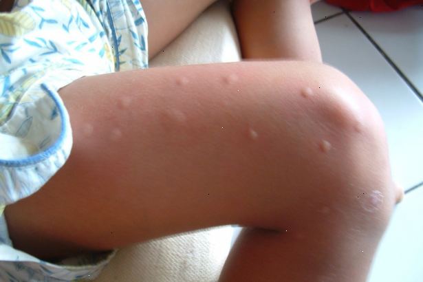 Hvordan man kan stoppe myggestik fra kløe. Håndtere de bider, når de først opstår.