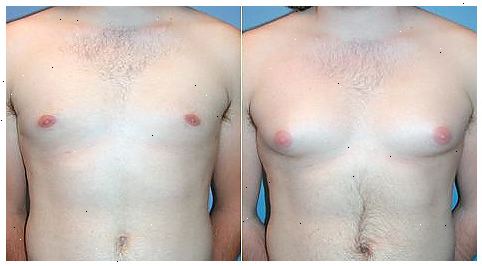 Hvordan man kan reducere mandlige bryst størrelse