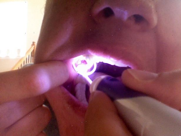 Hvordan til at behandle en tør socket. Vend tilbage til din mundtlige kirurg eller tandlæge.