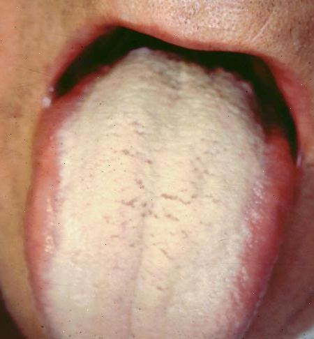 Hvordan at slippe af med hvid tunge. Start ved meget bunden af din tunge, placere tungen renere flugter din tunge overflade og gøre langsomme fejende strøg fra back-to-front.