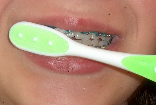 Sådan at børste dine tænder med seler på. Få en rengøring med din tandplejer.
