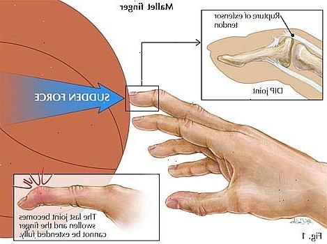 Hvordan til at behandle et fastklemt finger. Sørg for, at skaden ikke har resulteret i et knoglebrud.