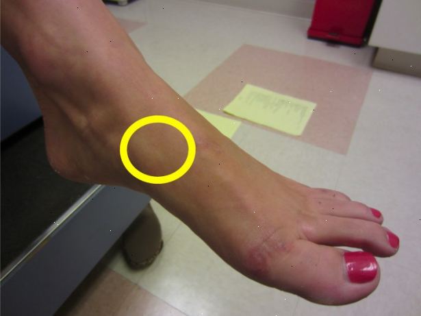 Hvordan til at behandle en fod stress fraktur. Genkende symptomerne på en stress fraktur i din fod.
