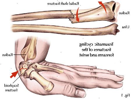 Hvordan giver førstehjælp til et brækket ben. Immobilisere skadede område, men ikke forsøge at flytte den til dens oprindelige position, medmindre omløb er afskåret (behandlet i et senere trin).